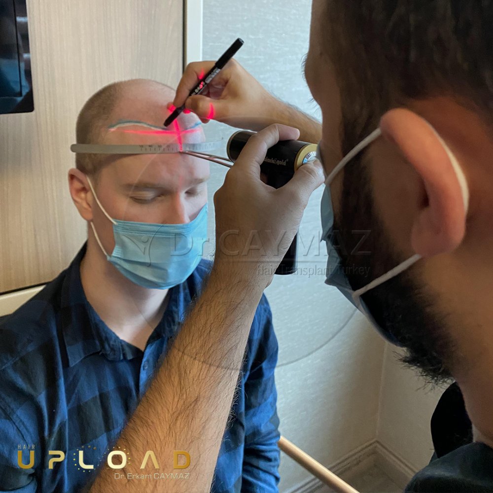 Hair transplant before & after result — frontal, kopfoberseite, kronenregion, 5,500 grafts, Sapphire FUE, 5 months post-op, Norwood 5 — Dr. Erkam Caymaz, Istanbul