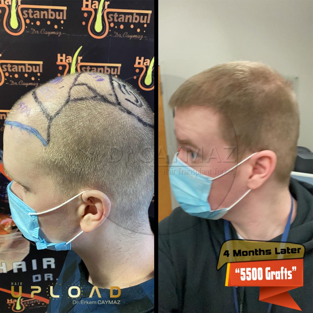 Hair transplant before & after result — frontal, kopfoberseite, kronenregion, 5,500 grafts, Sapphire FUE, 5 months post-op, Norwood 5 — Dr. Erkam Caymaz, Istanbul