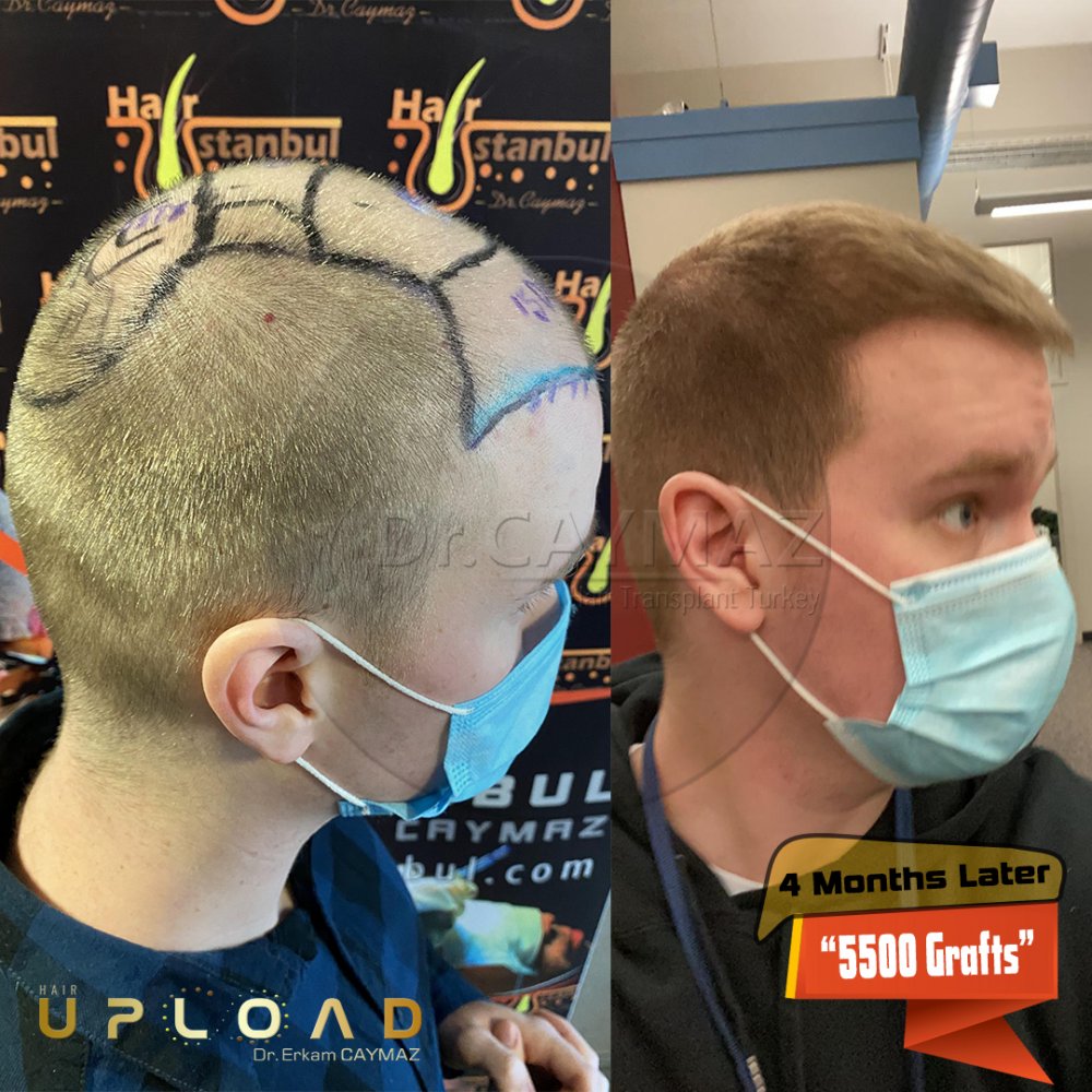 Hair transplant before & after result — frontal, kopfoberseite, kronenregion, 5,500 grafts, Sapphire FUE, 5 months post-op, Norwood 5 — Dr. Erkam Caymaz, Istanbul