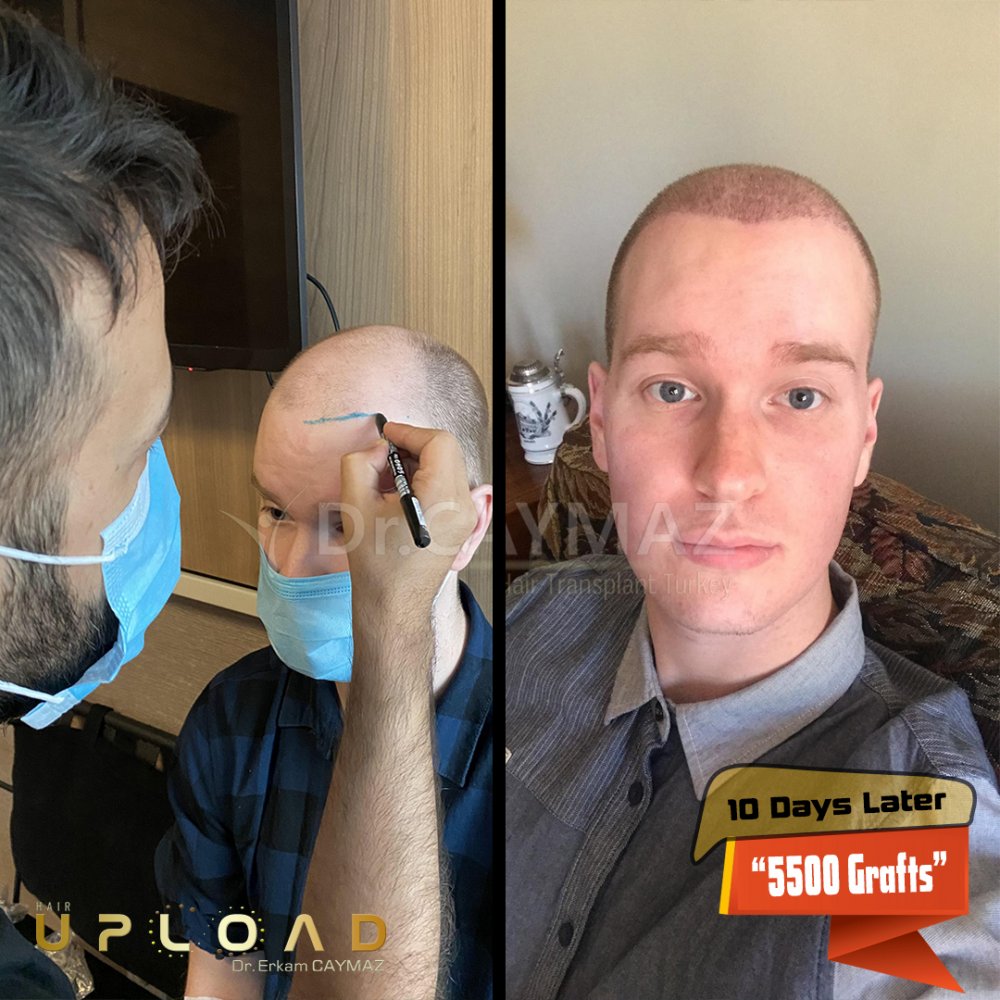 Hair transplant before & after result — frontal, kopfoberseite, kronenregion, 5,500 grafts, Sapphire FUE, 5 months post-op, Norwood 5 — Dr. Erkam Caymaz, Istanbul