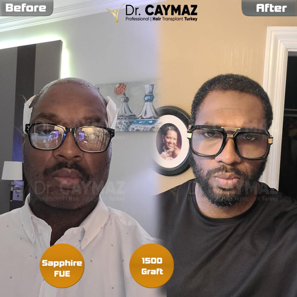 Mr Carmichael 1500 Graft Beard Transplantation Result — hair transplant before & after — bart, 1,500 grafts, Sapphire FUE, 7 months post-op — Dr. Erkam Caymaz, Istanbul
