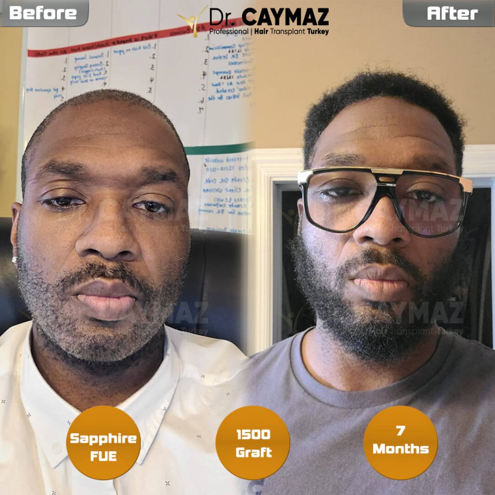 Mr Carmichael 1500 Graft Beard Transplantation Result — hair transplant before & after — bart, 1,500 grafts, Sapphire FUE, 7 months post-op — Dr. Erkam Caymaz, Istanbul