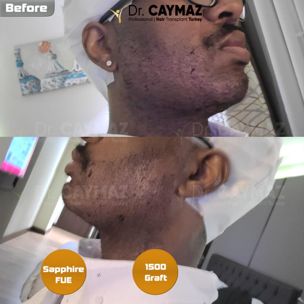 Mr Carmichael 1500 Graft Beard Transplantation Result — hair transplant before & after — bart, 1,500 grafts, Sapphire FUE, 7 months post-op — Dr. Erkam Caymaz, Istanbul
