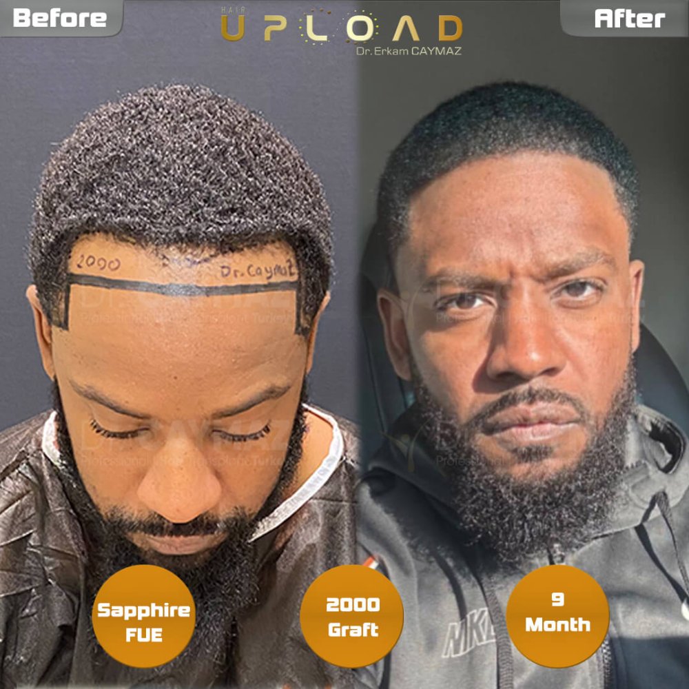 Hair transplant before & after result — frontal, 2,000 grafts, Sapphire FUE, 9 months post-op, Norwood 2 — Dr. Erkam Caymaz, Istanbul