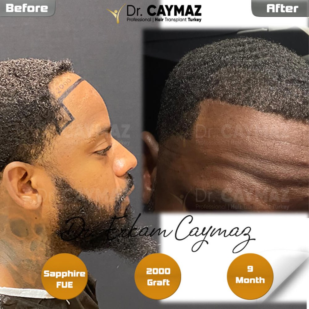 Hair transplant before & after result — frontal, 2,000 grafts, Sapphire FUE, 9 months post-op, Norwood 2 — Dr. Erkam Caymaz, Istanbul