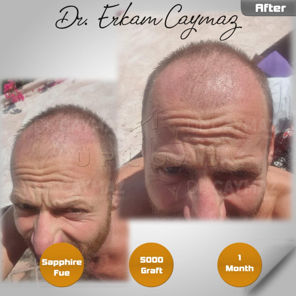 Hair transplant before & after result — frontal, kopfoberseite, kronenregion, 5,000 grafts, Sapphire FUE, 6 months post-op, Norwood 5 — Dr. Erkam Caymaz, Istanbul