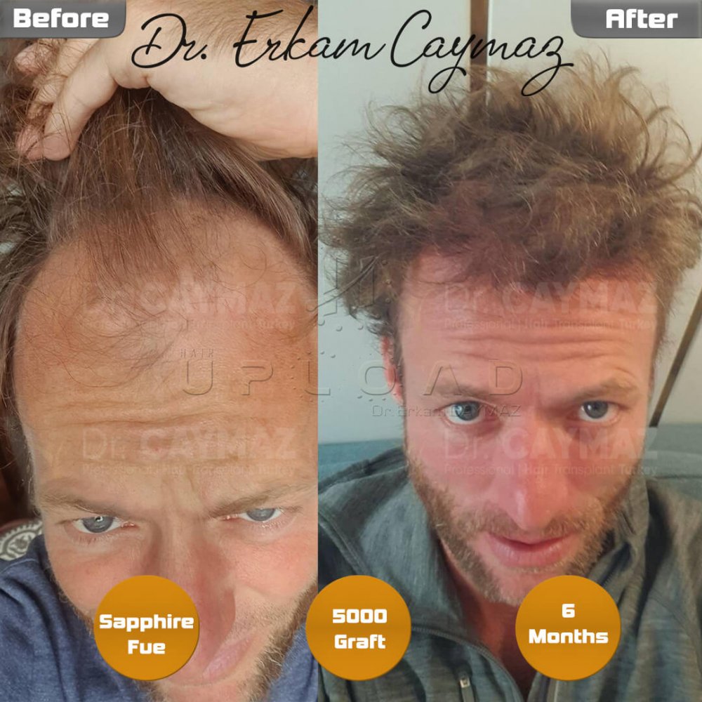 Hair transplant before & after result — frontal, kopfoberseite, kronenregion, 5,000 grafts, Sapphire FUE, 6 months post-op, Norwood 5 — Dr. Erkam Caymaz, Istanbul