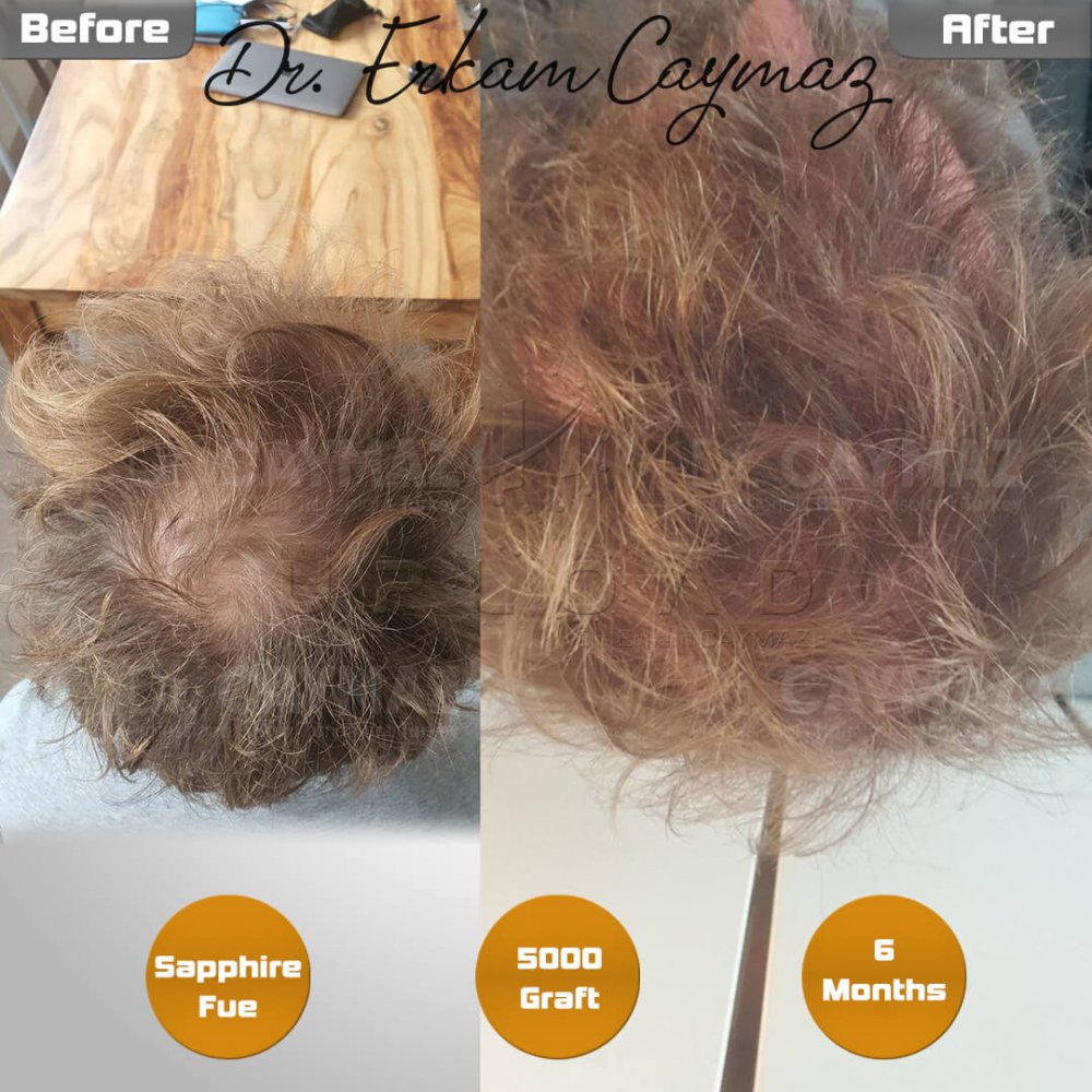 Hair transplant before & after result — frontal, kopfoberseite, kronenregion, 5,000 grafts, Sapphire FUE, 6 months post-op, Norwood 5 — Dr. Erkam Caymaz, Istanbul