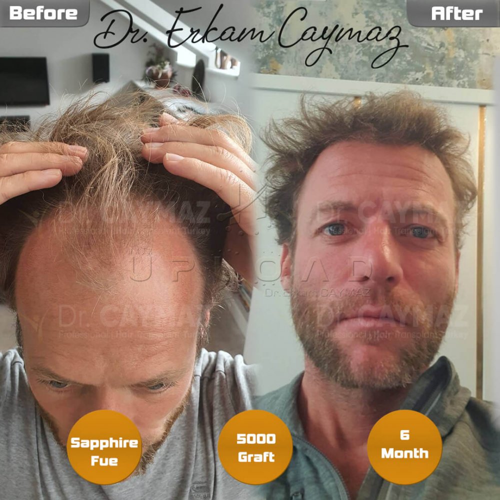 Hair transplant before & after result — frontal, kopfoberseite, kronenregion, 5,000 grafts, Sapphire FUE, 6 months post-op, Norwood 5 — Dr. Erkam Caymaz, Istanbul