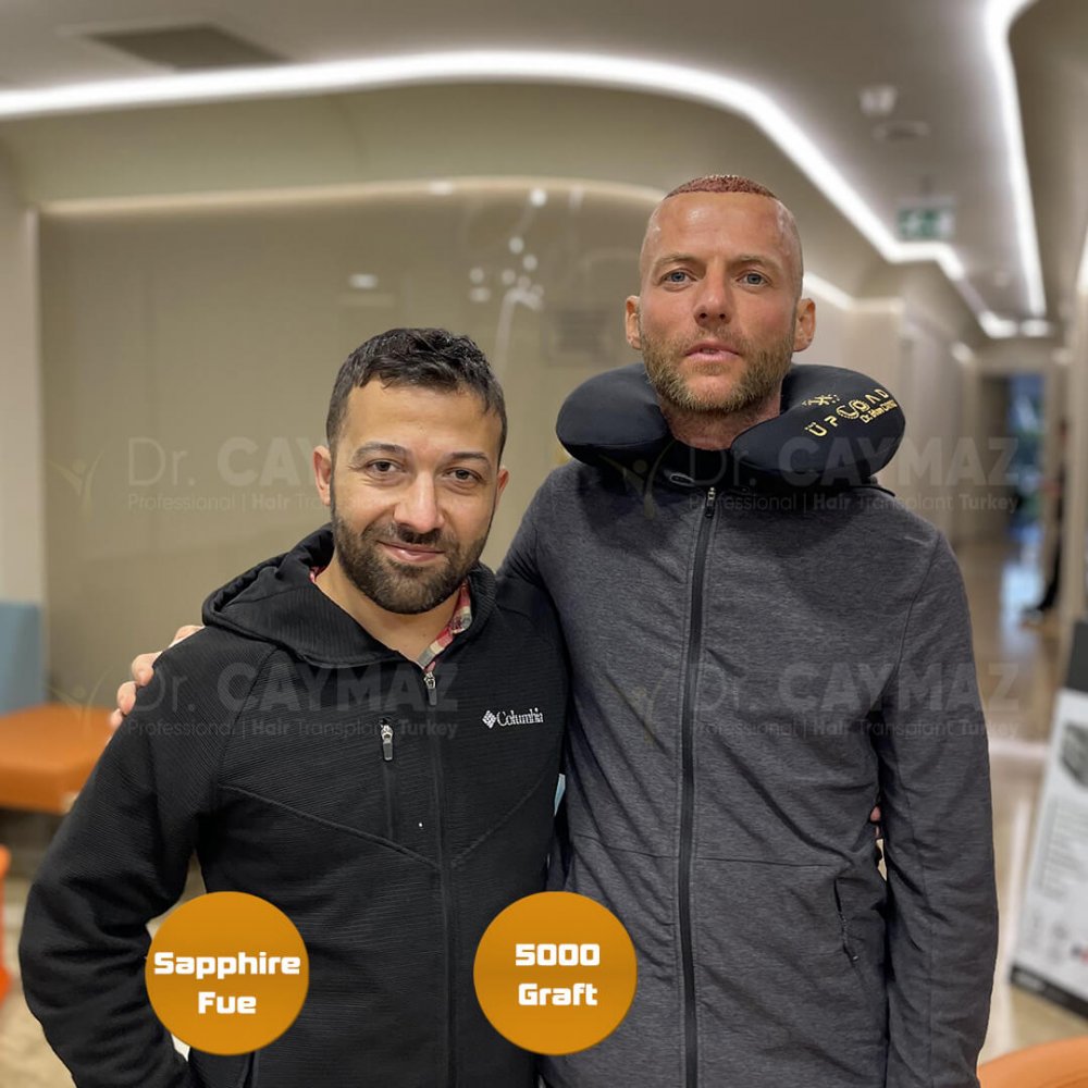 Hair transplant before & after result — frontal, kopfoberseite, kronenregion, 5,000 grafts, Sapphire FUE, 6 months post-op, Norwood 5 — Dr. Erkam Caymaz, Istanbul