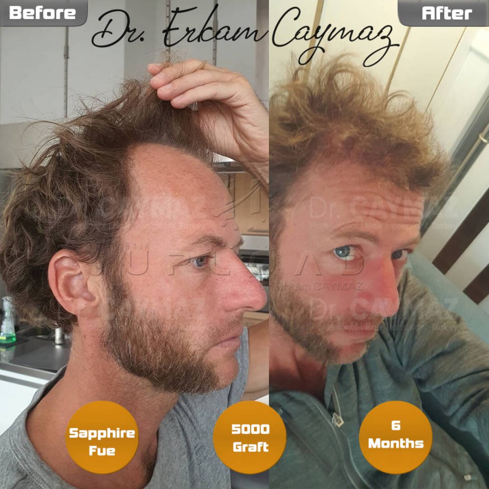 Hair transplant before & after result — frontal, kopfoberseite, kronenregion, 5,000 grafts, Sapphire FUE, 6 months post-op, Norwood 5 — Dr. Erkam Caymaz, Istanbul