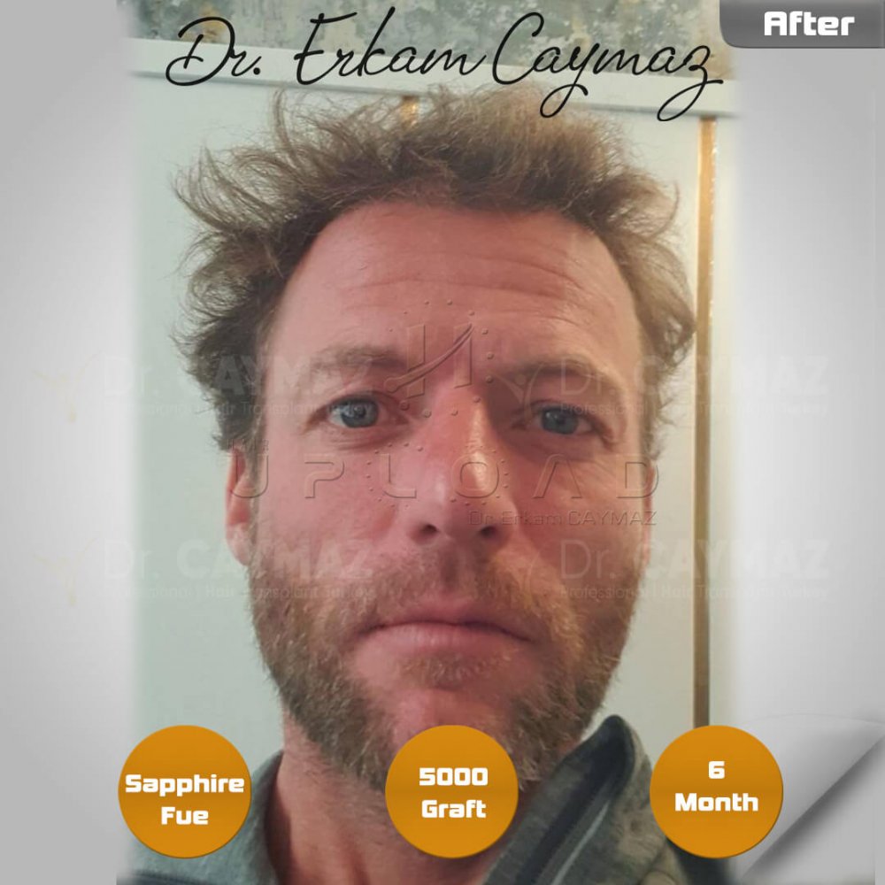 Hair transplant before & after result — frontal, kopfoberseite, kronenregion, 5,000 grafts, Sapphire FUE, 6 months post-op, Norwood 5 — Dr. Erkam Caymaz, Istanbul