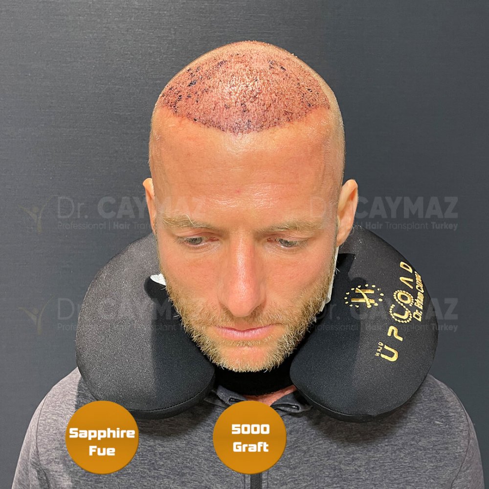 Hair transplant before & after result — frontal, kopfoberseite, kronenregion, 5,000 grafts, Sapphire FUE, 6 months post-op, Norwood 5 — Dr. Erkam Caymaz, Istanbul