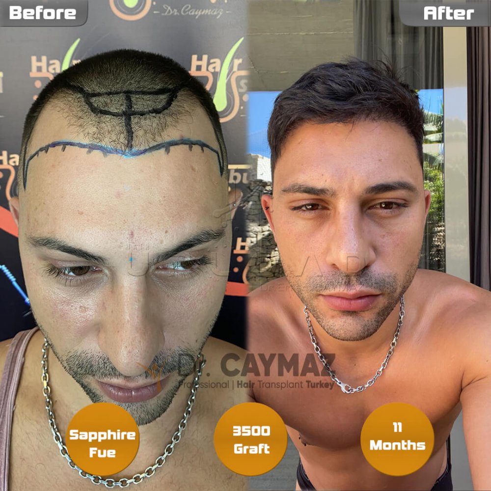 Hair transplant before & after result — frontal, sienes, 3,500 grafts, Sapphire FUE, 12 months post-op, Norwood 4 — Dr. Erkam Caymaz, Istanbul