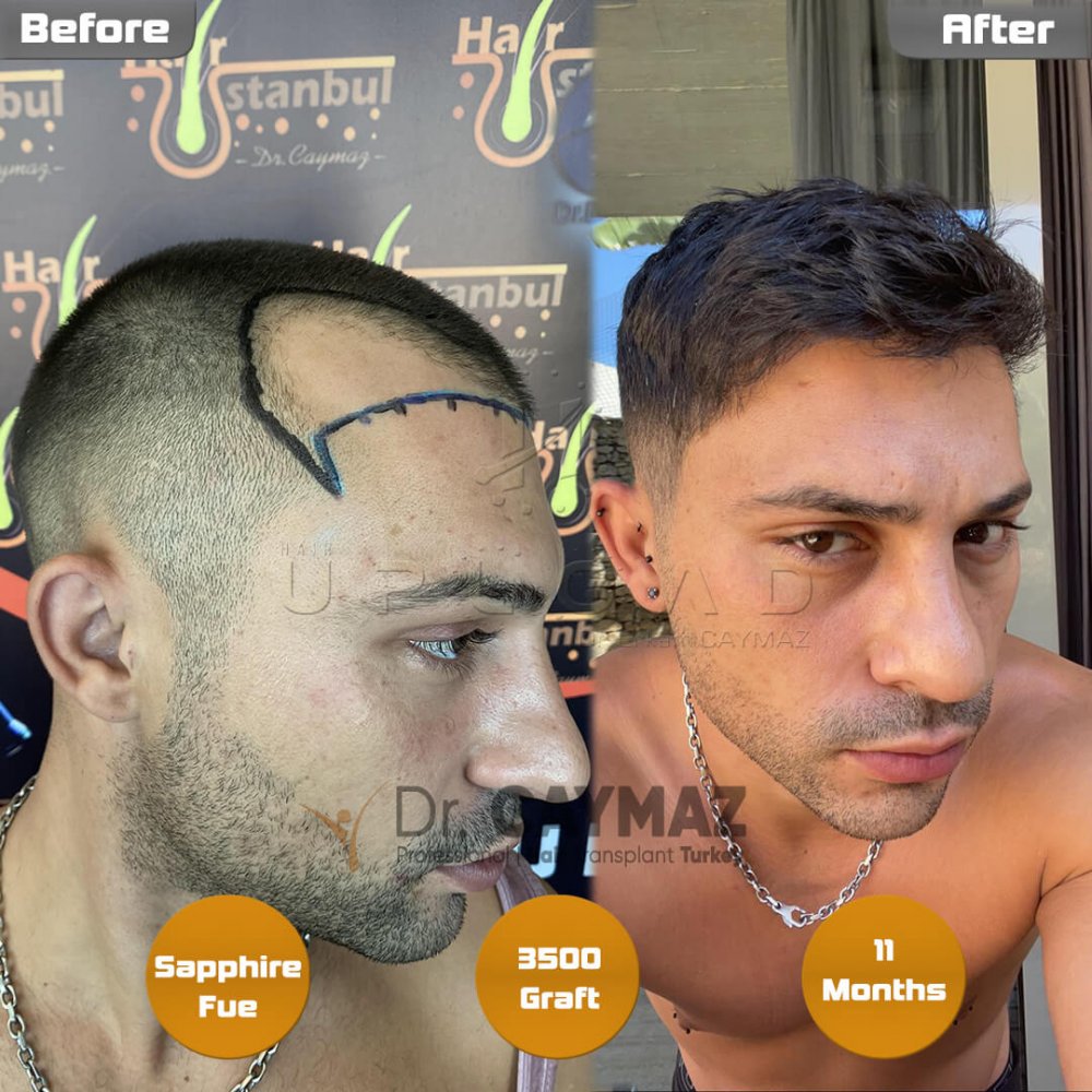 Hair transplant before & after result — frontal, sienes, 3,500 grafts, Sapphire FUE, 12 months post-op, Norwood 4 — Dr. Erkam Caymaz, Istanbul