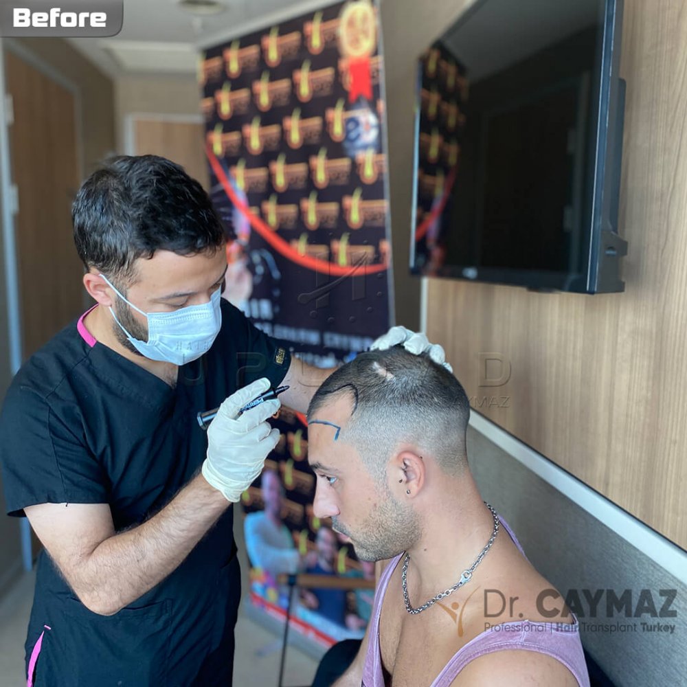 Hair transplant before & after result — frontal, sienes, 3,500 grafts, Sapphire FUE, 12 months post-op, Norwood 4 — Dr. Erkam Caymaz, Istanbul