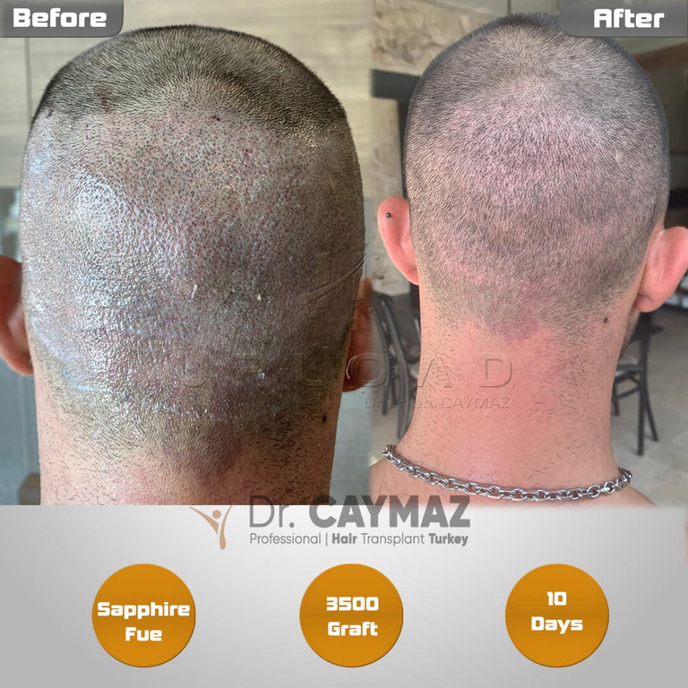 Hair transplant before & after result — frontal, sienes, 3,500 grafts, Sapphire FUE, 12 months post-op, Norwood 4 — Dr. Erkam Caymaz, Istanbul