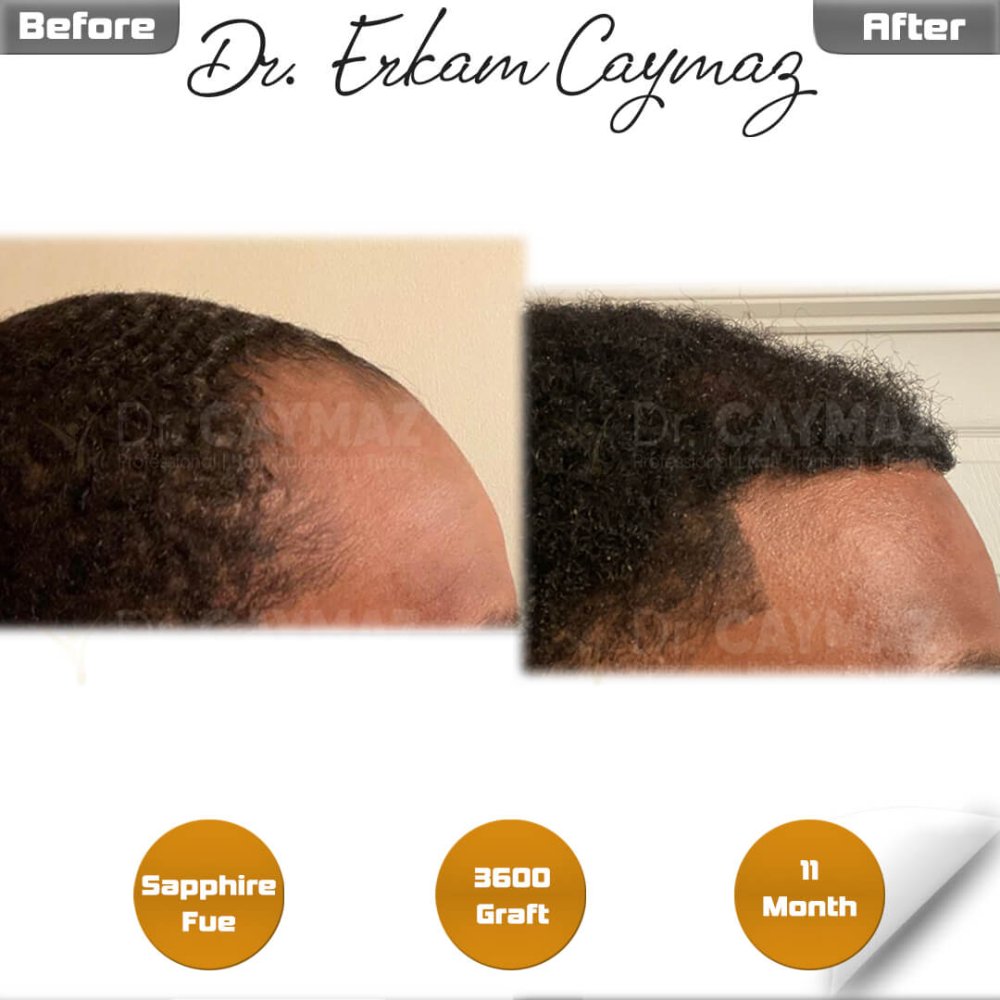 Hair transplant before & after result — frontal, schläfen, 3,600 grafts, Sapphire FUE, 12 months post-op, Norwood 3 — Dr. Erkam Caymaz, Istanbul