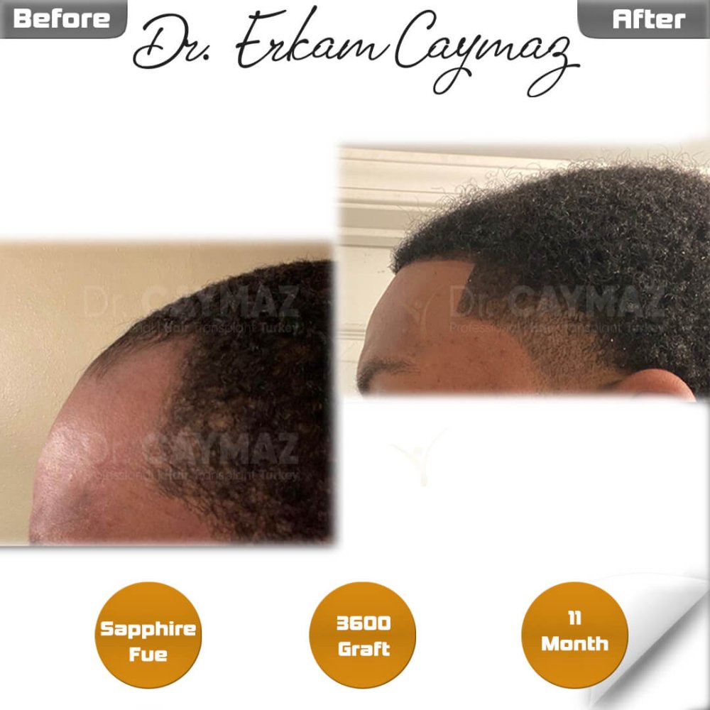 Hair transplant before & after result — frontal, schläfen, 3,600 grafts, Sapphire FUE, 12 months post-op, Norwood 3 — Dr. Erkam Caymaz, Istanbul
