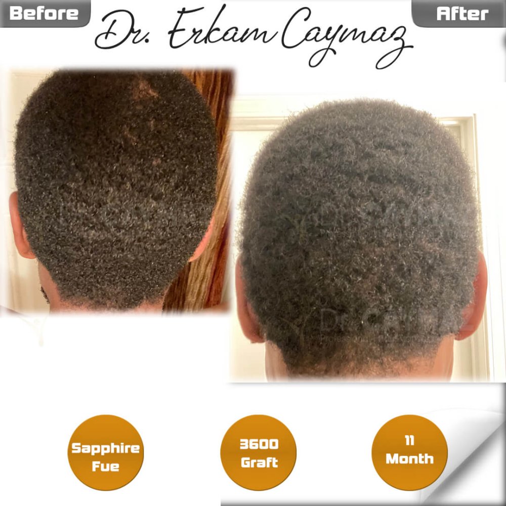 Hair transplant before & after result — frontal, schläfen, 3,600 grafts, Sapphire FUE, 12 months post-op, Norwood 3 — Dr. Erkam Caymaz, Istanbul