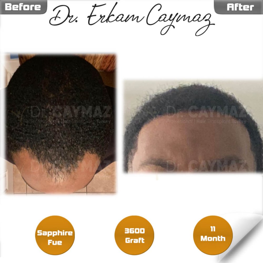 Hair transplant before & after result — frontal, schläfen, 3,600 grafts, Sapphire FUE, 12 months post-op, Norwood 3 — Dr. Erkam Caymaz, Istanbul