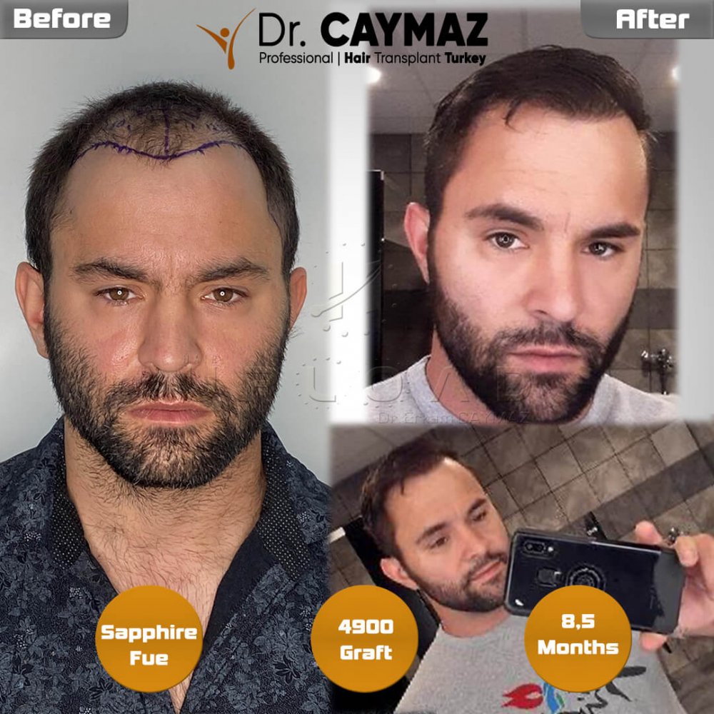 Hair transplant before & after result — frontal, parte superior, corona, 4,900 grafts, Sapphire FUE, 12 months post-op, Norwood 6 — Dr. Erkam Caymaz, Istanbul