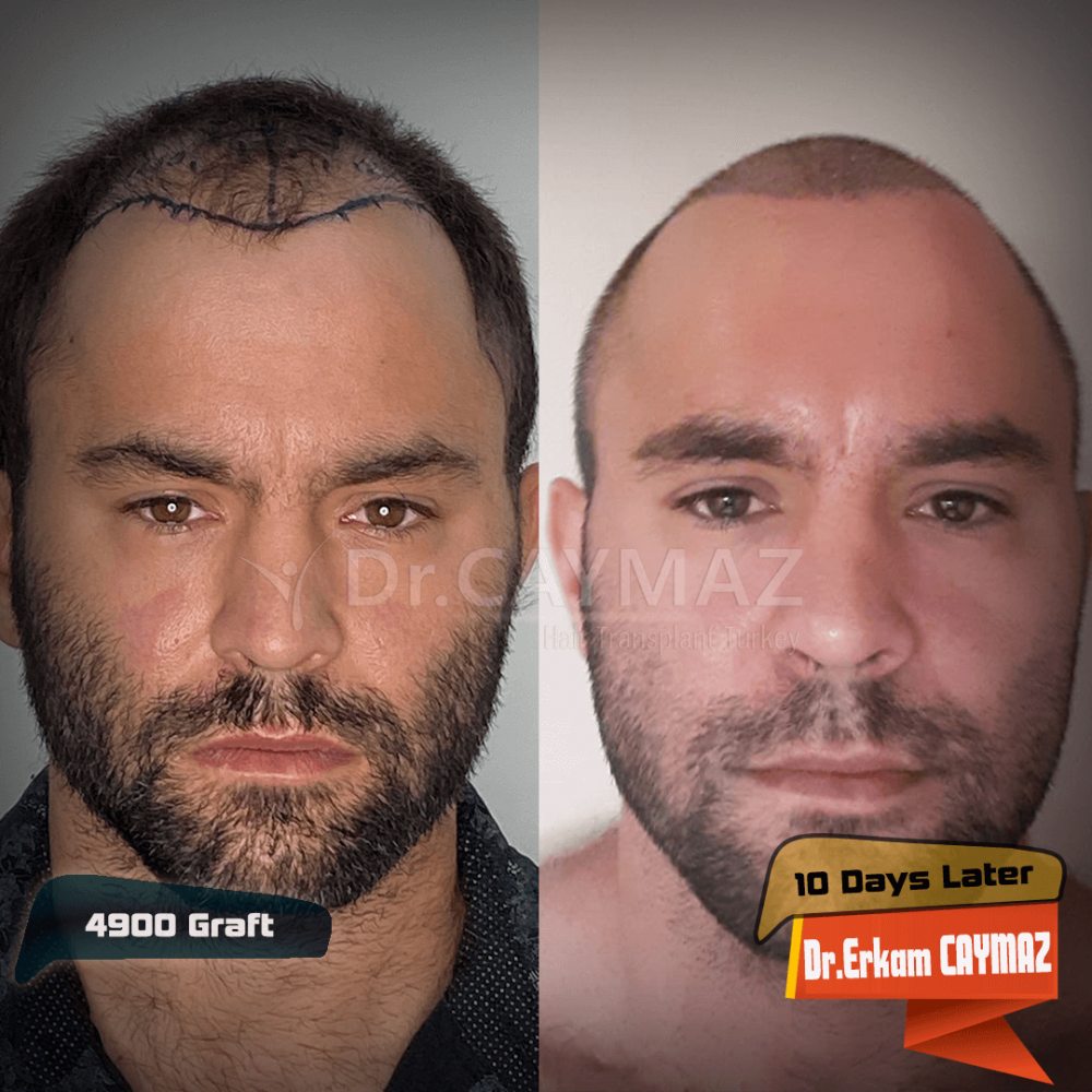 Hair transplant before & after result — frontal, parte superior, corona, 4,900 grafts, Sapphire FUE, 12 months post-op, Norwood 6 — Dr. Erkam Caymaz, Istanbul