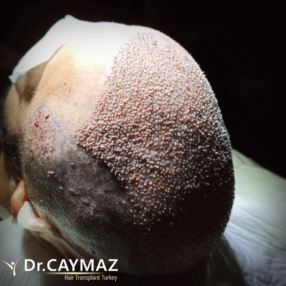 Hair transplant before & after result — frontal, parte superior, corona, 4,900 grafts, Sapphire FUE, 12 months post-op, Norwood 6 — Dr. Erkam Caymaz, Istanbul