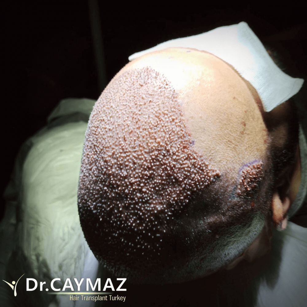 Hair transplant before & after result — frontal, parte superior, corona, 4,900 grafts, Sapphire FUE, 12 months post-op, Norwood 6 — Dr. Erkam Caymaz, Istanbul