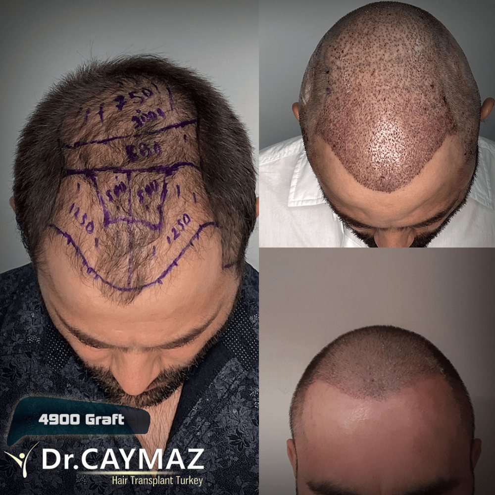 Hair transplant before & after result — frontal, parte superior, corona, 4,900 grafts, Sapphire FUE, 12 months post-op, Norwood 6 — Dr. Erkam Caymaz, Istanbul