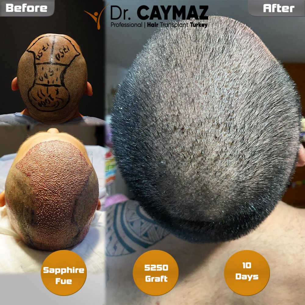 Hair transplant before & after result — frontal, top of head, crown, 5,250 grafts, Sapphire FUE, 5 months post-op, Norwood 6 — Dr. Erkam Caymaz, Istanbul
