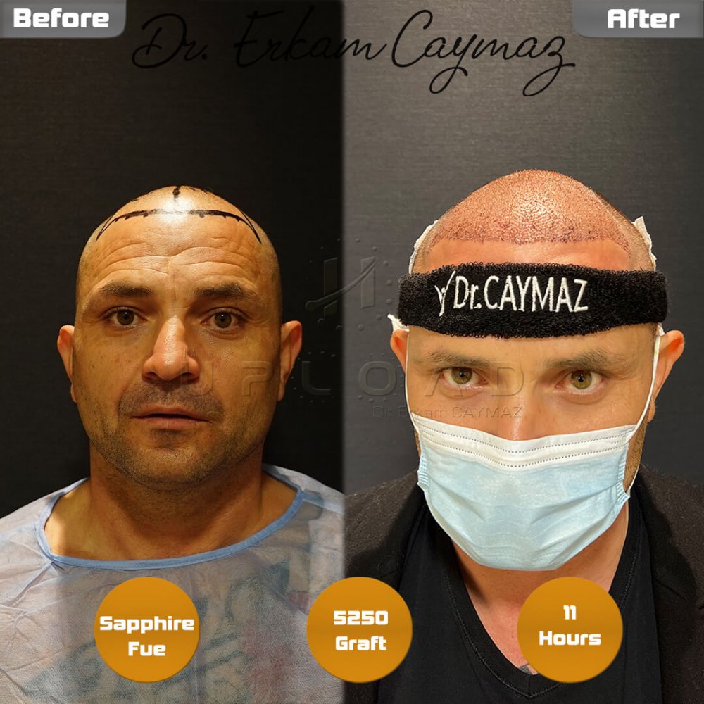 Hair transplant before & after result — frontal, top of head, crown, 5,250 grafts, Sapphire FUE, 5 months post-op, Norwood 6 — Dr. Erkam Caymaz, Istanbul