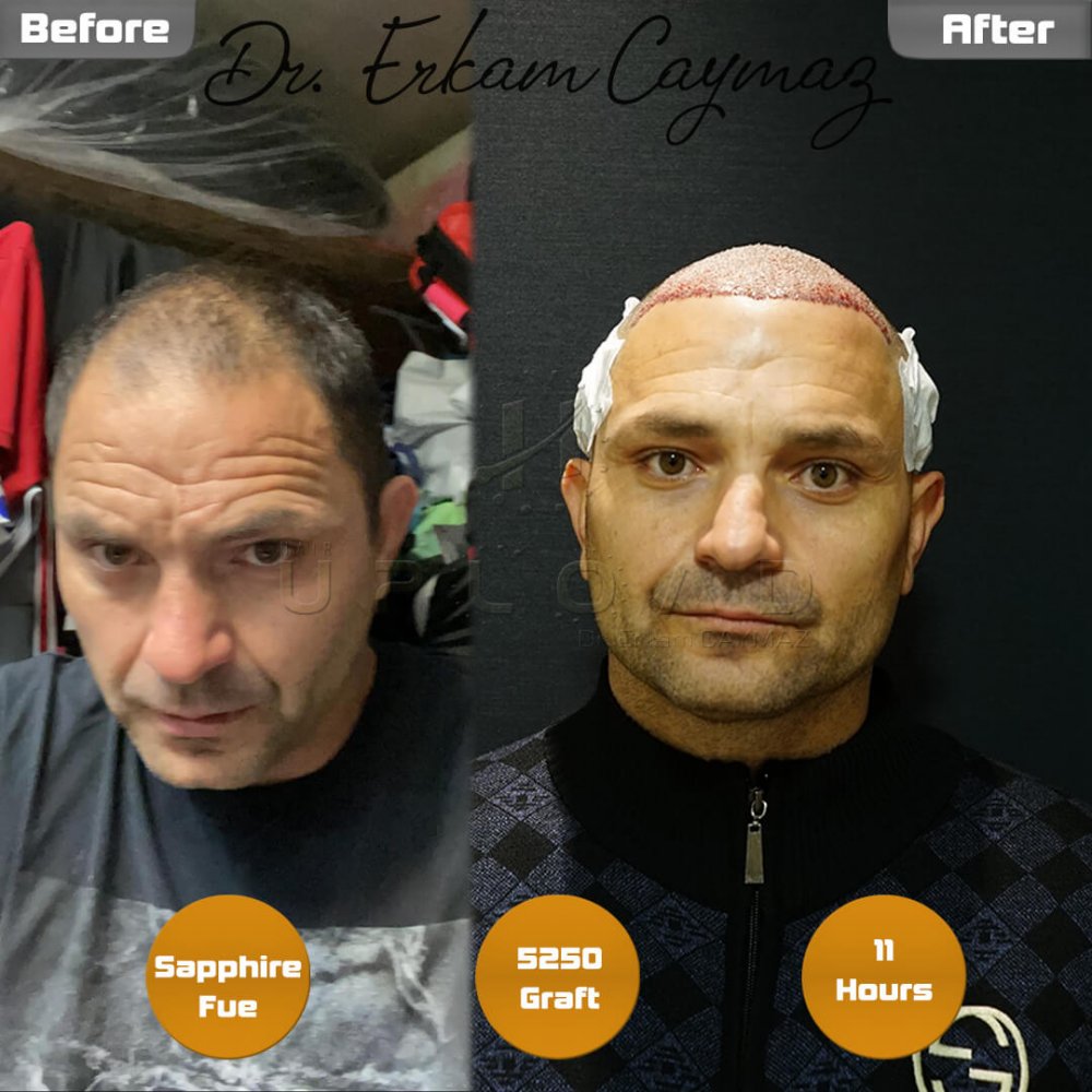 Hair transplant before & after result — frontal, top of head, crown, 5,250 grafts, Sapphire FUE, 5 months post-op, Norwood 6 — Dr. Erkam Caymaz, Istanbul