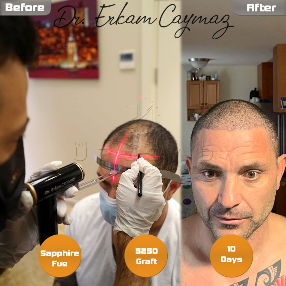 Hair transplant before & after result — frontal, top of head, crown, 5,250 grafts, Sapphire FUE, 5 months post-op, Norwood 6 — Dr. Erkam Caymaz, Istanbul