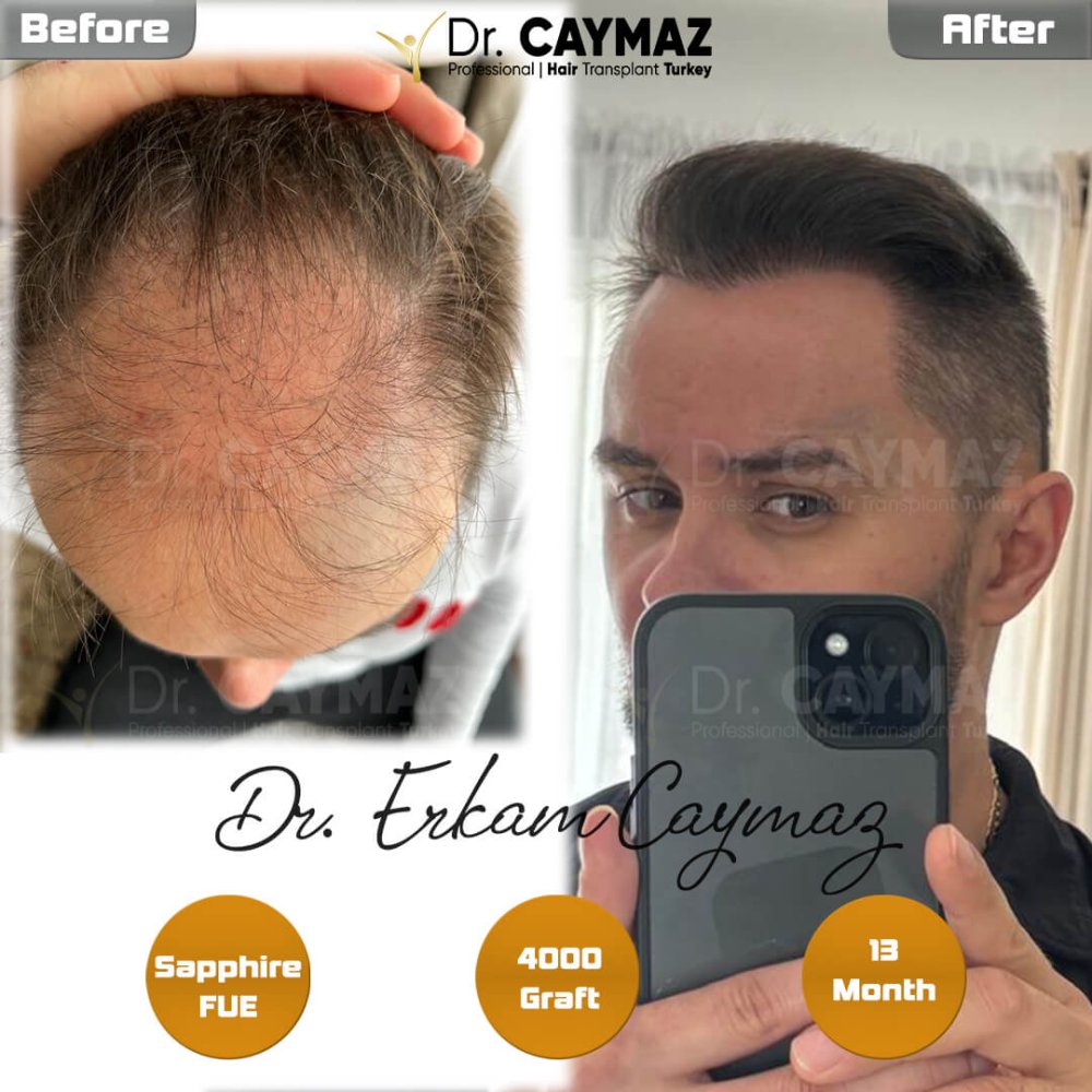 Hair transplant before & after result — frontal, kopfoberseite, 4,000 grafts, Sapphire FUE, 12 months post-op, Norwood 4 — Dr. Erkam Caymaz, Istanbul