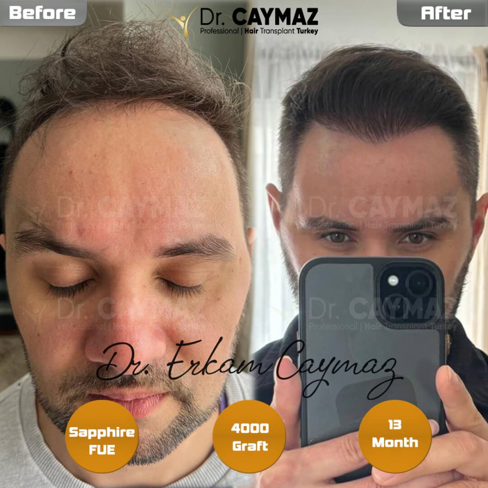 Hair transplant before & after result — frontal, kopfoberseite, 4,000 grafts, Sapphire FUE, 12 months post-op, Norwood 4 — Dr. Erkam Caymaz, Istanbul