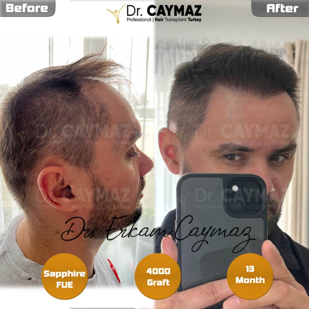 Hair transplant before & after result — frontal, kopfoberseite, 4,000 grafts, Sapphire FUE, 12 months post-op, Norwood 4 — Dr. Erkam Caymaz, Istanbul