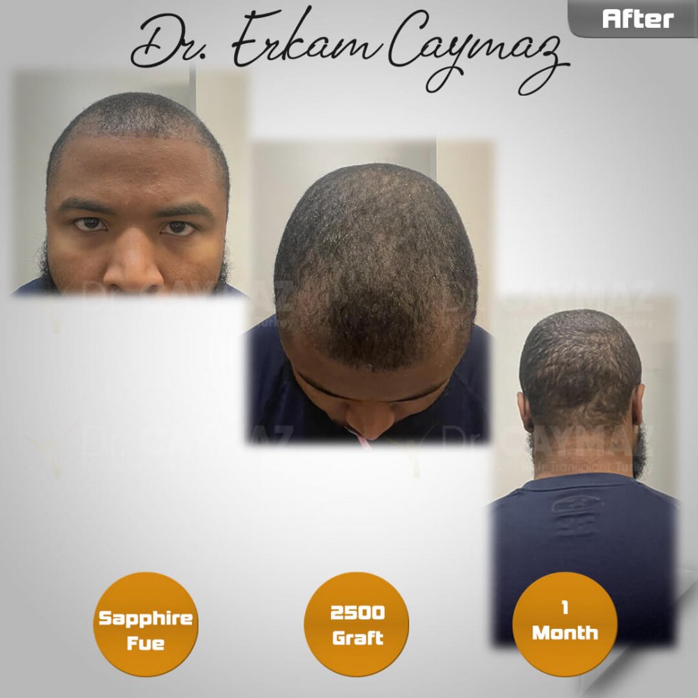 Hair transplant before & after result — frontal, 2,500 grafts, Sapphire FUE, 5 months post-op, Norwood 2 — Dr. Erkam Caymaz, Istanbul