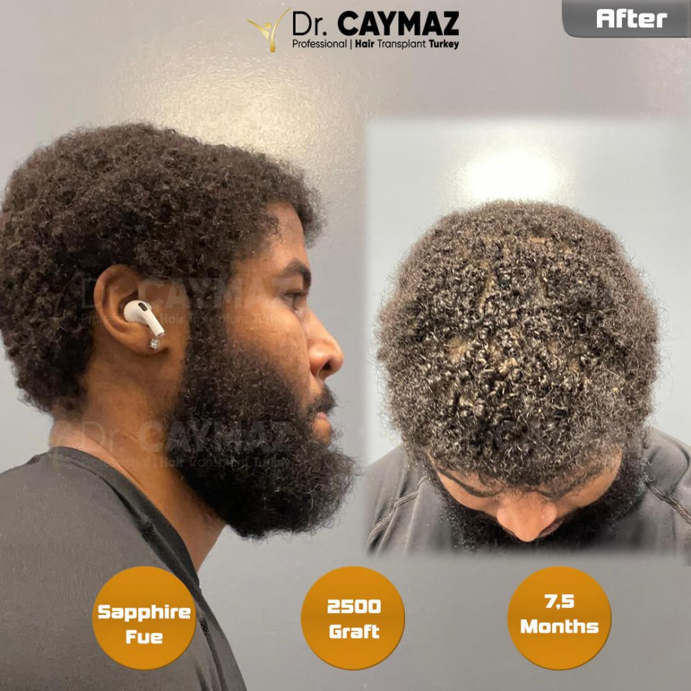 Hair transplant before & after result — frontal, 2,500 grafts, Sapphire FUE, 5 months post-op, Norwood 2 — Dr. Erkam Caymaz, Istanbul