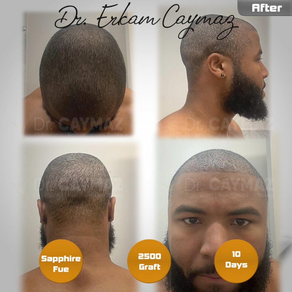 Hair transplant before & after result — frontal, 2,500 grafts, Sapphire FUE, 5 months post-op, Norwood 2 — Dr. Erkam Caymaz, Istanbul