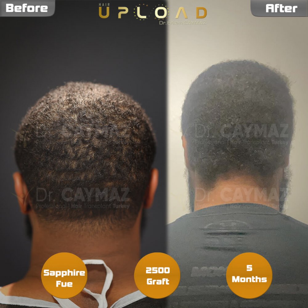 Hair transplant before & after result — frontal, 2,500 grafts, Sapphire FUE, 5 months post-op, Norwood 2 — Dr. Erkam Caymaz, Istanbul