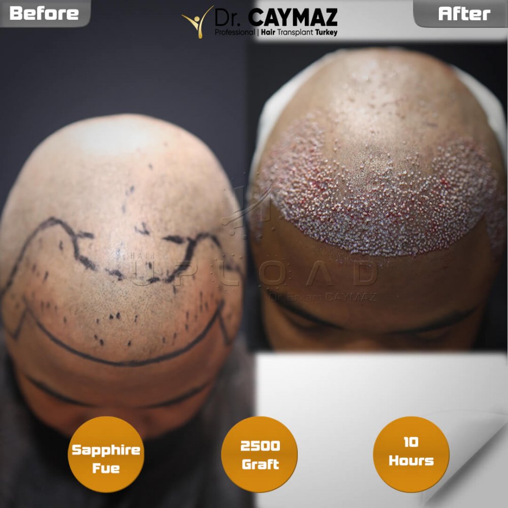 Hair transplant before & after result — frontal, 2,500 grafts, Sapphire FUE, 5 months post-op, Norwood 2 — Dr. Erkam Caymaz, Istanbul