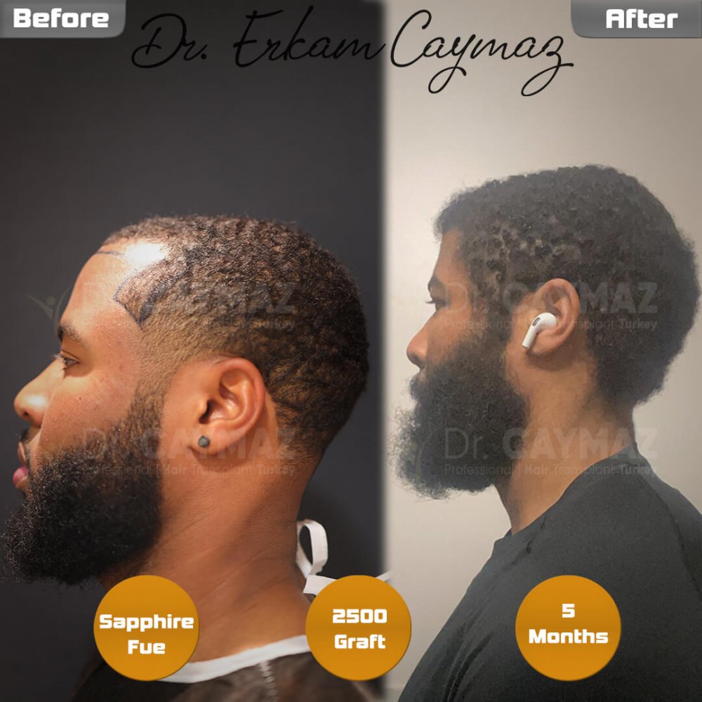 Hair transplant before & after result — frontal, 2,500 grafts, Sapphire FUE, 5 months post-op, Norwood 2 — Dr. Erkam Caymaz, Istanbul