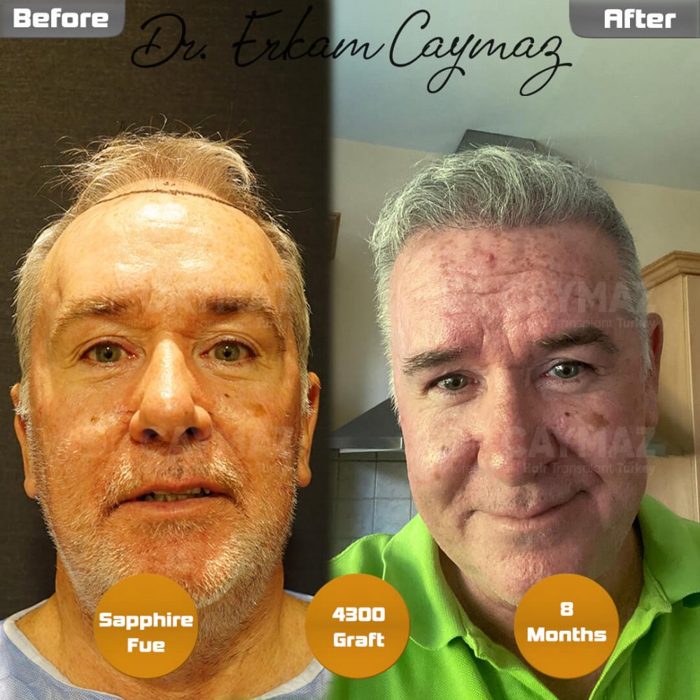 Hair transplant before & after result — frontal, kopfoberseite, 4,300 grafts, Sapphire FUE, 8 months post-op, Norwood 5 — Dr. Erkam Caymaz, Istanbul