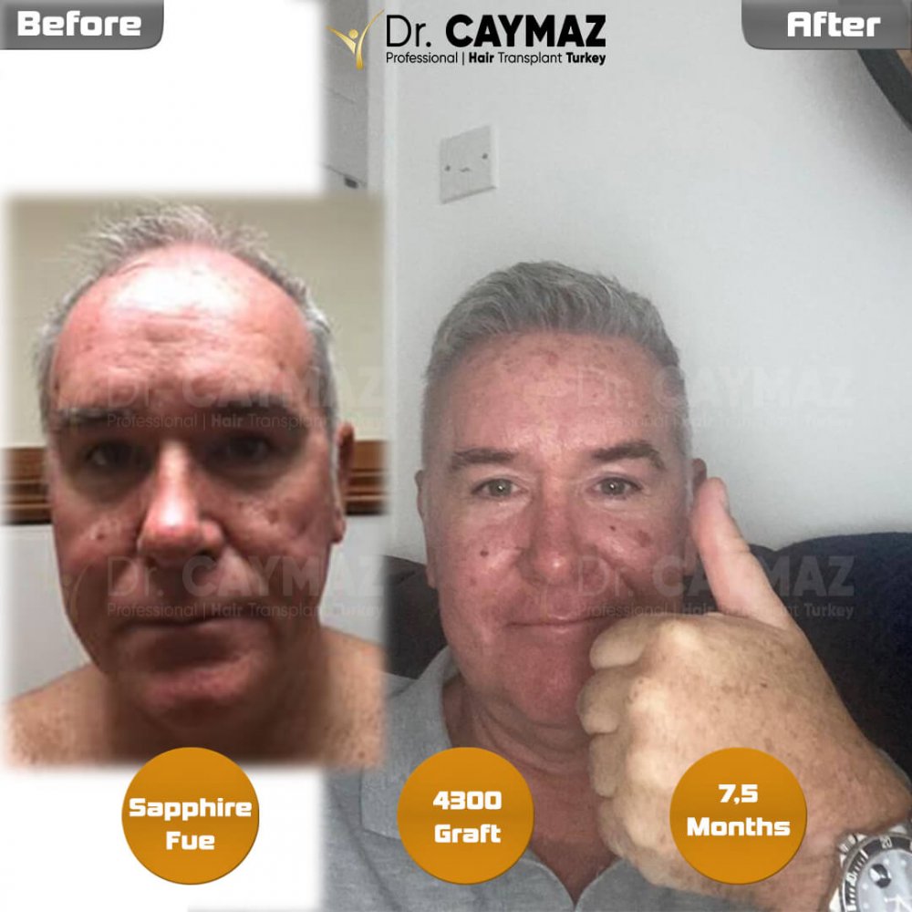 Hair transplant before & after result — frontal, kopfoberseite, 4,300 grafts, Sapphire FUE, 8 months post-op, Norwood 5 — Dr. Erkam Caymaz, Istanbul