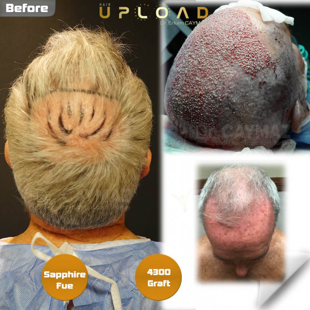 Hair transplant before & after result — frontal, kopfoberseite, 4,300 grafts, Sapphire FUE, 8 months post-op, Norwood 5 — Dr. Erkam Caymaz, Istanbul