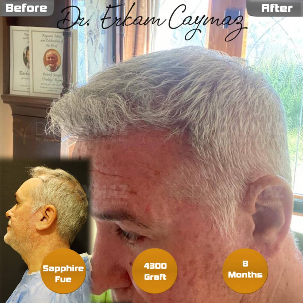 Hair transplant before & after result — frontal, kopfoberseite, 4,300 grafts, Sapphire FUE, 8 months post-op, Norwood 5 — Dr. Erkam Caymaz, Istanbul