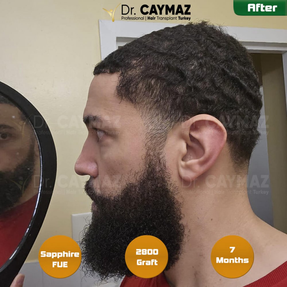 Hair transplant before & after result — frontal, 2,800 grafts, Sapphire FUE, 7 months post-op, Norwood 3 — Dr. Erkam Caymaz, Istanbul