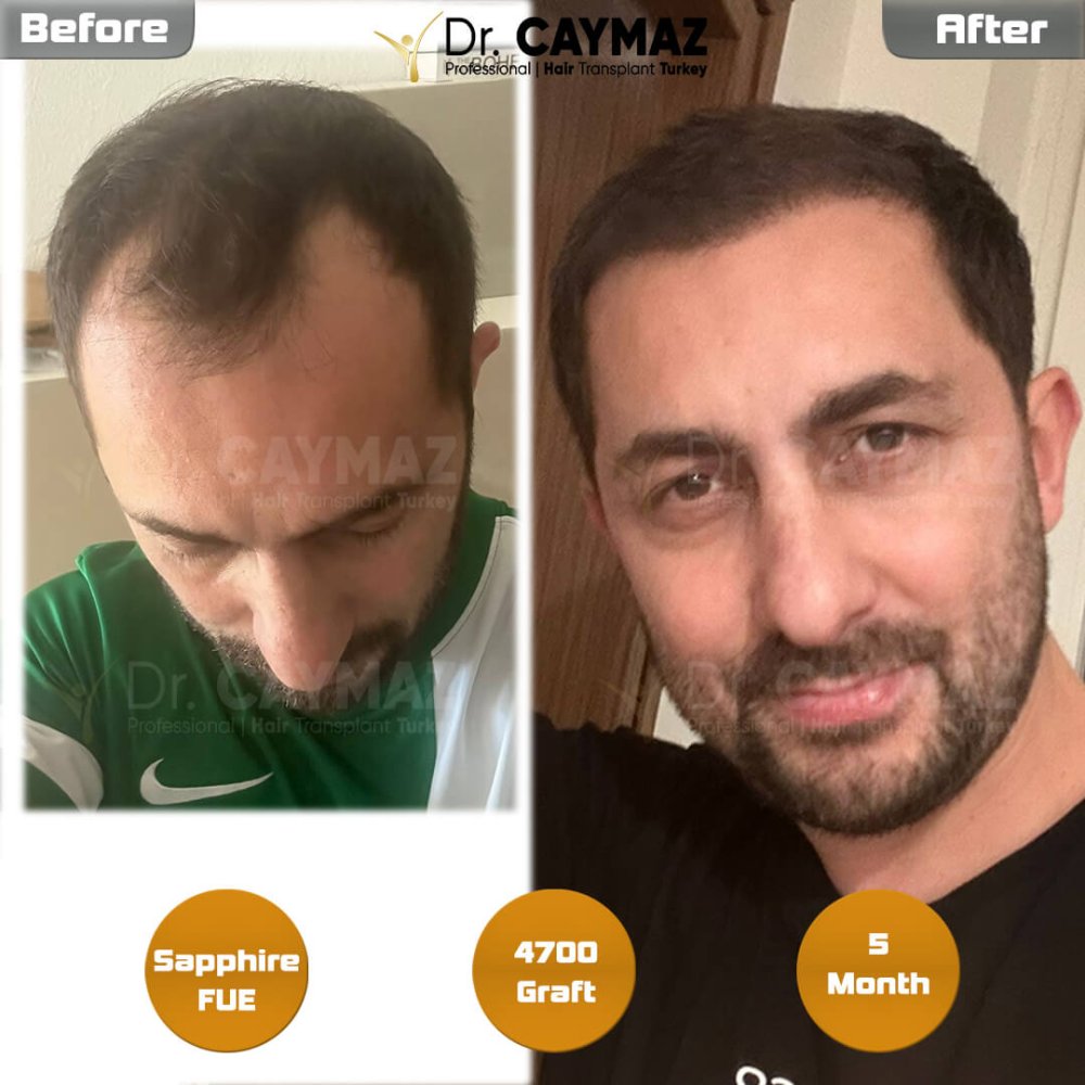 Hair transplant before & after result — 4,700 grafts, Sapphire FUE, 6 months post-op, Norwood 5 — Dr. Erkam Caymaz, Istanbul