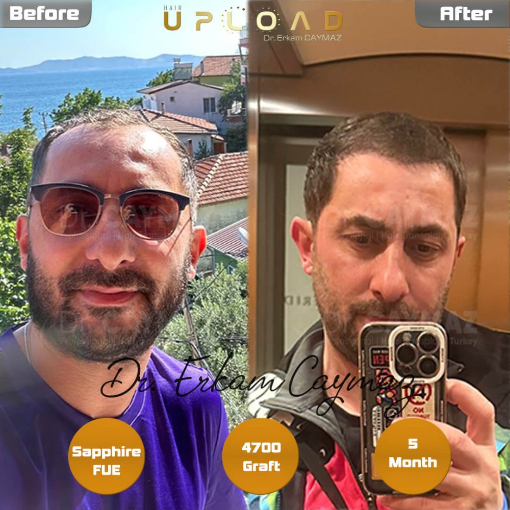 Hair transplant before & after result — 4,700 grafts, Sapphire FUE, 6 months post-op, Norwood 5 — Dr. Erkam Caymaz, Istanbul